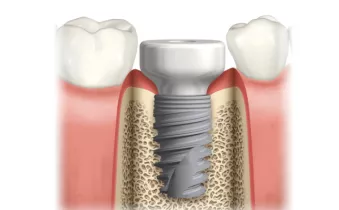 NobelActive WP with PEEK Healing Abutment