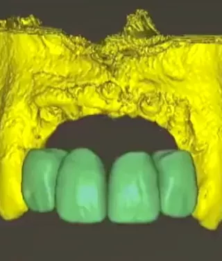 Dental implant treatment planning for esthetic results: Video