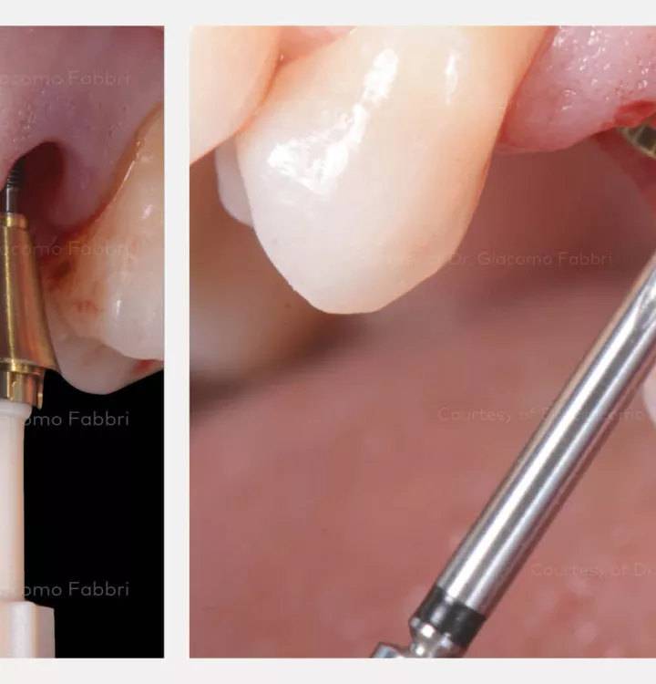 N1 dental implant placed with plastic handle