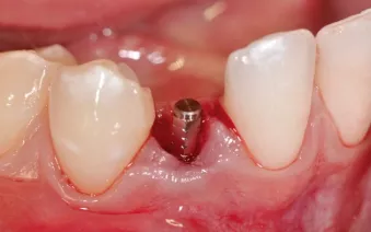 The tooth has been extracted and a 1.5 mm collar provisional abutment has been inserted onto the implant and torqued to 15 Ncm. A flapless approach has been employed.