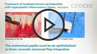 Treatment of localized chronic periodontitis with hyperplastic inflammatory tissue - mandible