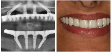 Patient treated with the All-on-4® treatment concept in both the mandible and maxilla