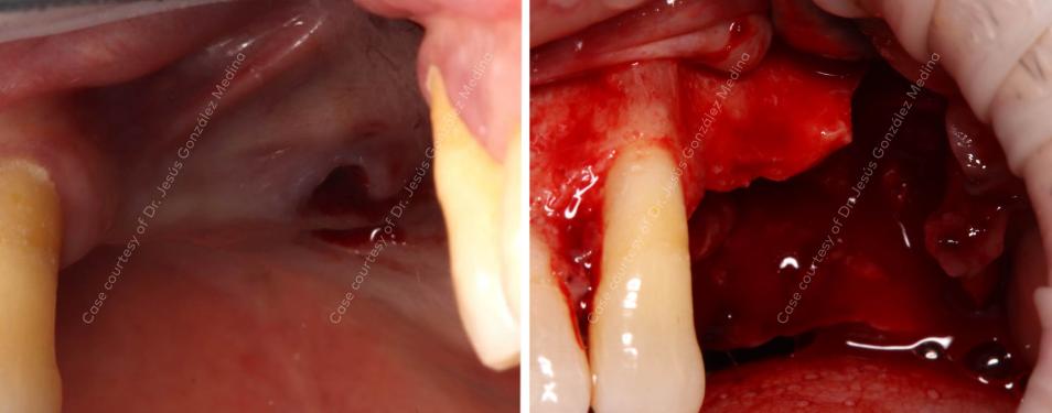 Nobel Biocare extraction of periodontally compromised tooth