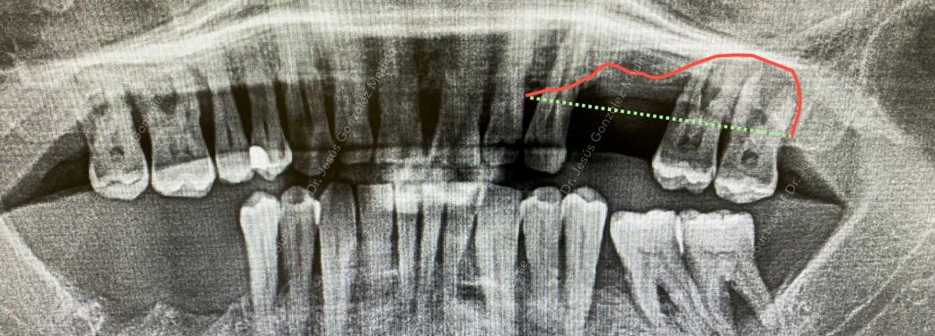 Nobel Biocare OPG reveals the bone defect in maxillary region
