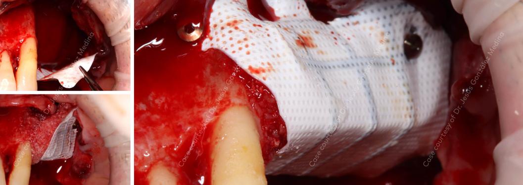 Nobel Biocare Creos syntoprotect membrane placed with composite