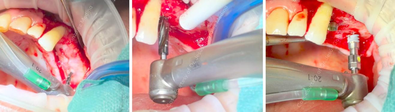 Nobel Biocare Osteotomy and NobelActive® TiUltra