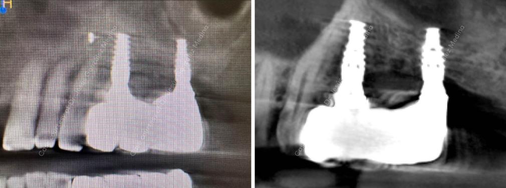 Nobel Biocare 2-year follow-up - Postoperative radiograph
