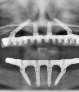 All-on-4 Implant scan