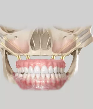 Quad zygoma procedure
