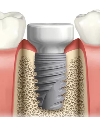 NobelActive WP with PEEK Healing Abutment