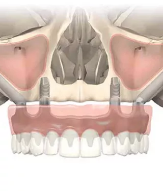 NobelZygoma