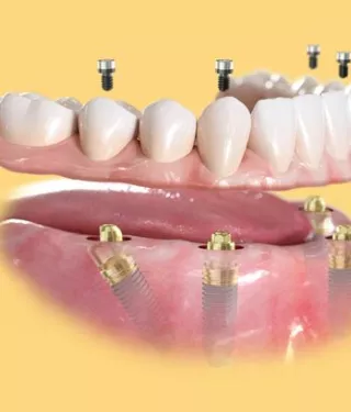 All-on-4 treatment concept components close-up view