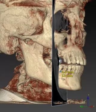 Top tips for re-treatment of dental implant failures: Dr Giorgio Tabanella