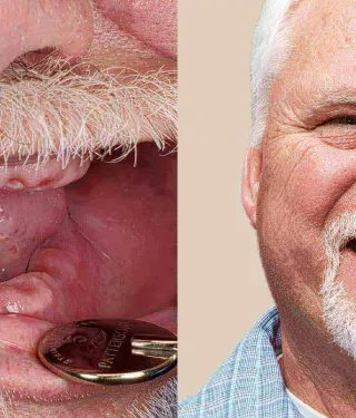 Tim rediscovers his smile with NobelProcera