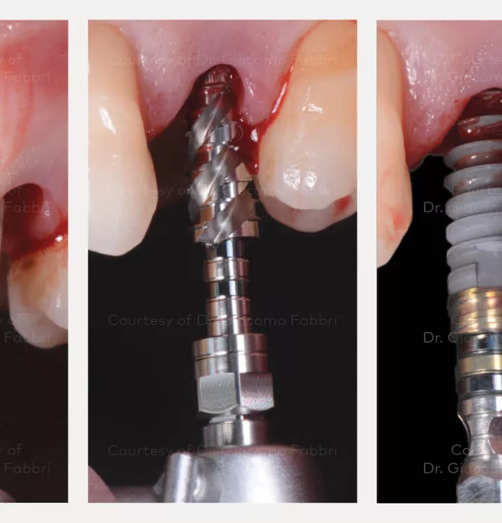 Implant preparation