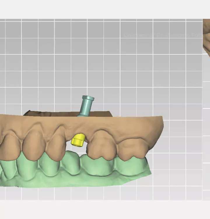 Design and planning of final dental restoration with DTX Studio Implant