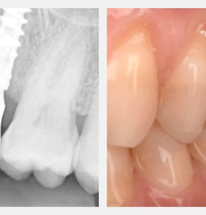 X-ray and clinical evaluation after 9 months of function.