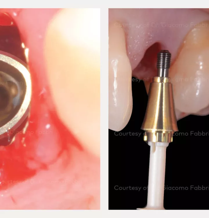 Implant placement