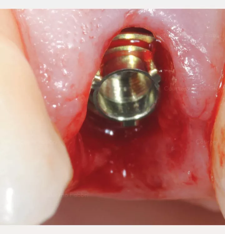N1 dental implant in situ