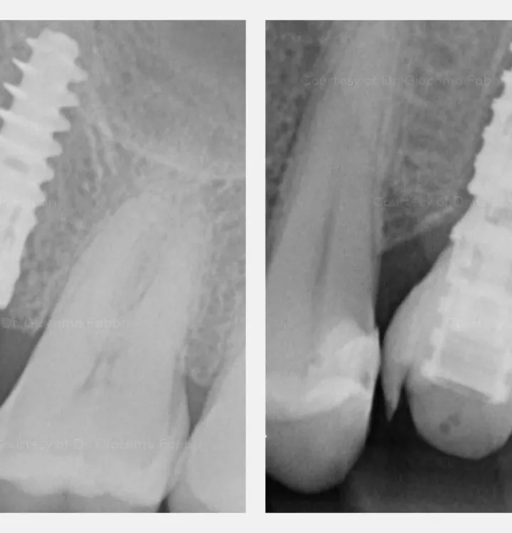 X-ray evaluation after the surgery