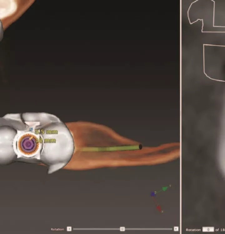 Digitally designed surgical guide to be utilized in fully guided surgical protocol. Implant position based solely on final restoration position and contours.