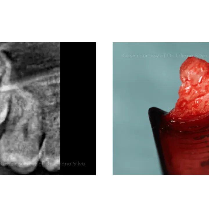 Case courtesy of Dr. Liliana Silva