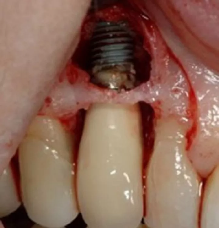 When a flap was raised the bone loss became apparent, as did the cement around the implant!