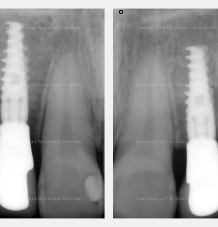 Case courtesy of Dr. Zufía and Dr. Dalmau