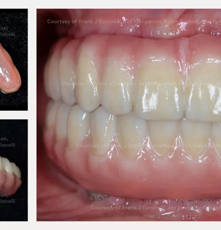 Case courtesy of Dr. Tuminelli, Dr. Neugarten, Dr. Epstein, Dr. Brovnick and Dr. Pigliacelli