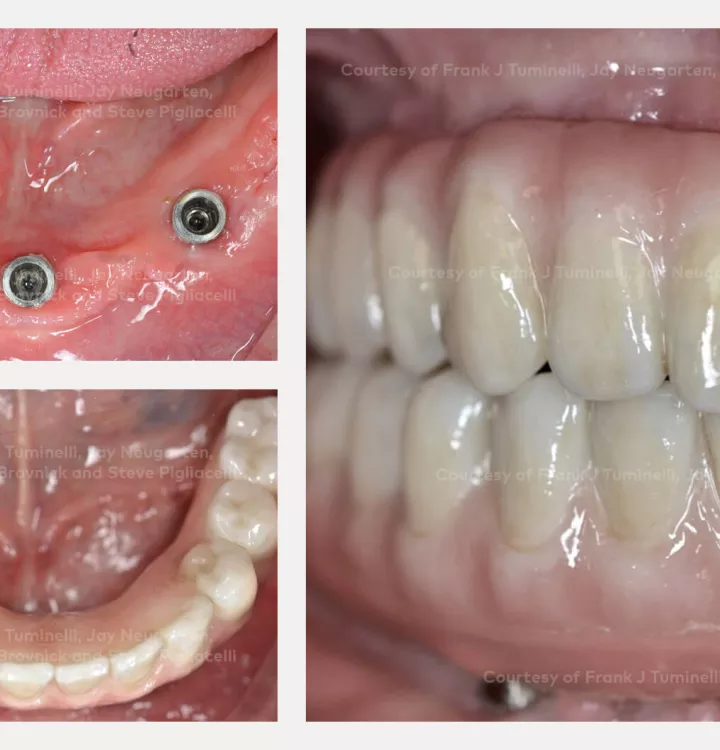 Case courtesy of Dr. Tuminelli, Dr. Neugarten, Dr. Epstein, Dr. Brovnick and Dr. Pigliacelli