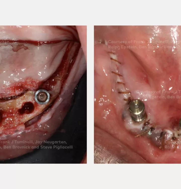 Case courtesy of Dr. Tuminelli, Dr. Neugarten, Dr. Epstein, Dr. Brovnick and Dr. Pigliacelli