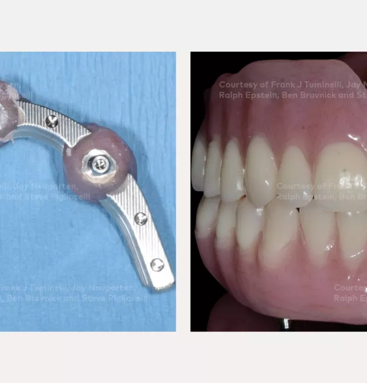 Case courtesy of Dr. Tuminelli, Dr. Neugarten, Dr. Epstein, Dr. Brovnick and Dr. Pigliacelli