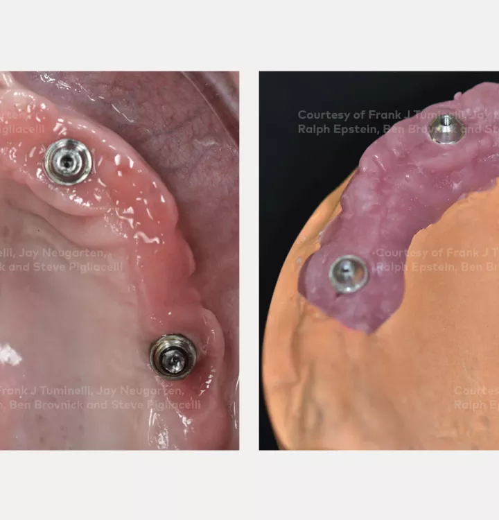 Case courtesy of Dr. Tuminelli, Dr. Neugarten, Dr. Epstein, Dr. Brovnick and Dr. Pigliacelli