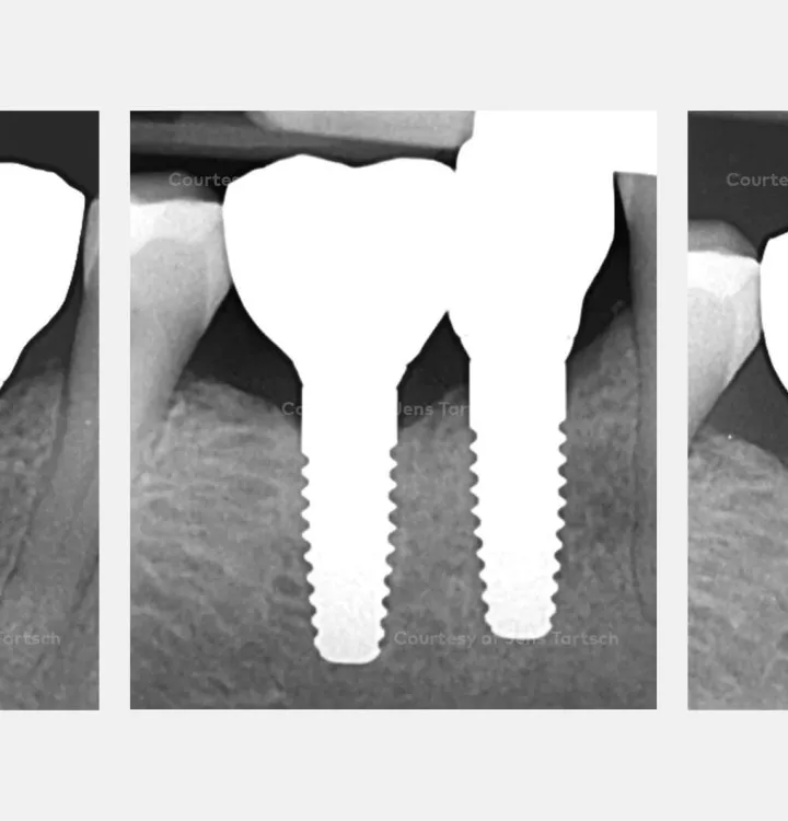 Case courtesy of Dr. Tartsch