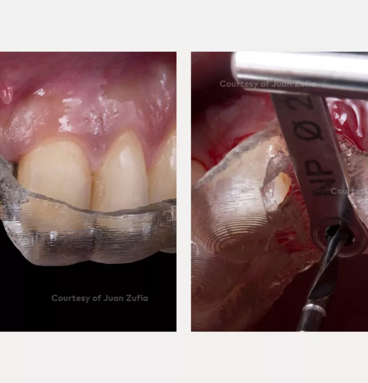 Case courtesy of Dr. Zufía