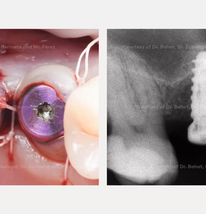 Case courtesy of Dr. Bahat, Dr. Zabalegui, Dr.Berroeta and Mr. Pérez