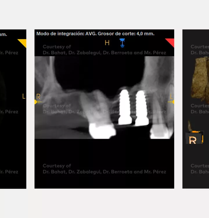 Case courtesy of Dr. Bahat, Dr. Zabalegui, Dr.Berroeta and Mr. Pérez