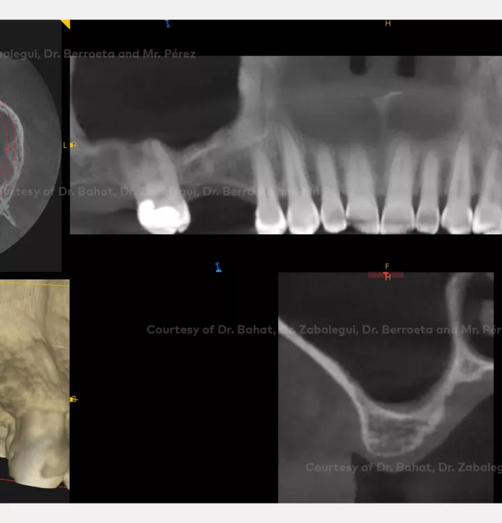 Case courtesy of Dr. Bahat, Dr. Zabalegui, Dr.Berroeta and Mr. Pérez