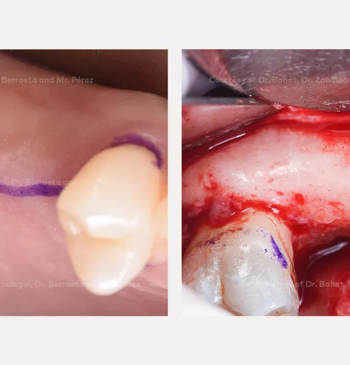 Case courtesy of Dr. Bahat, Dr. Zabalegui, Dr.Berroeta and Mr. Pérez