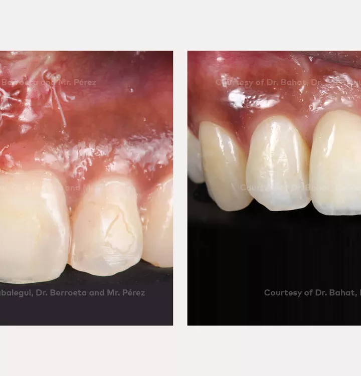 Case courtesy of Dr. Bahat, Dr. Zabalegui, Dr.Berroeta and Mr. Pérez