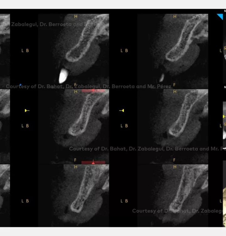 Case courtesy of Dr. Bahat, Dr. Zabalegui, Dr.Berroeta and Mr. Pérez