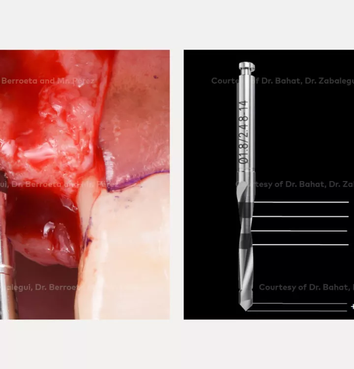 Case courtesy of Dr. Bahat, Dr. Zabalegui, Dr.Berroeta and Mr. Pérez