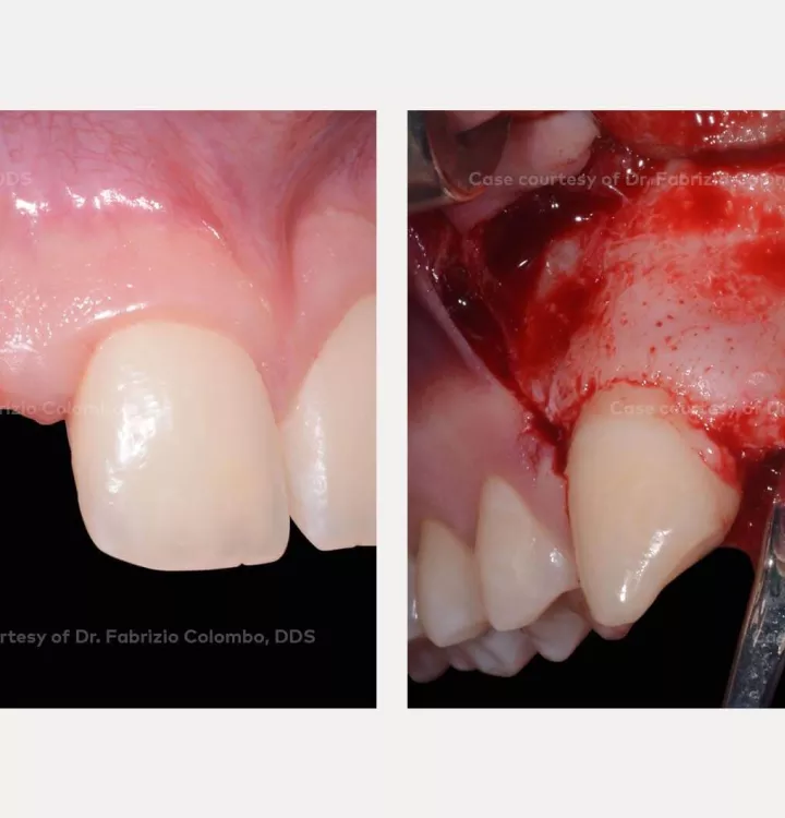 Zahnbelag (Plaque) - Leading Implant Centers