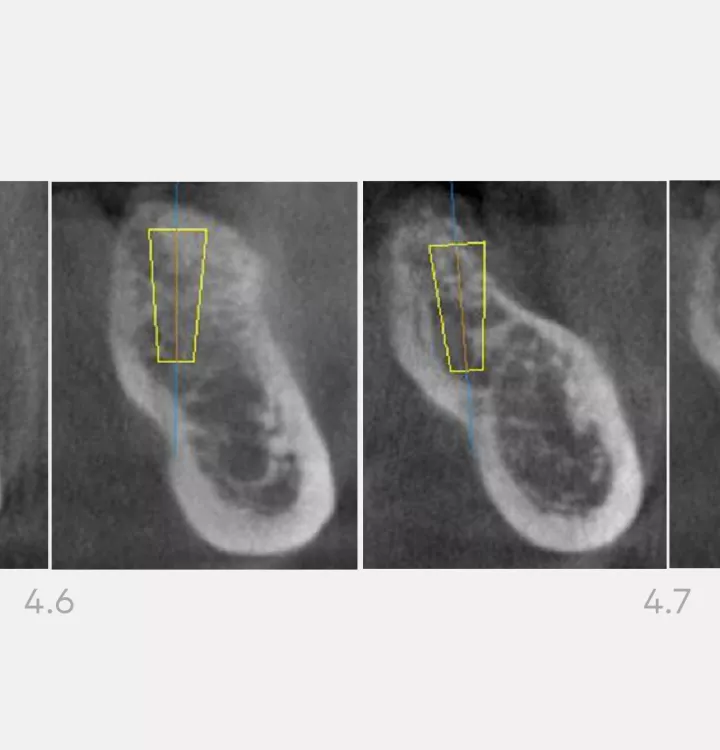 Nobel Biocare Clinical Case
