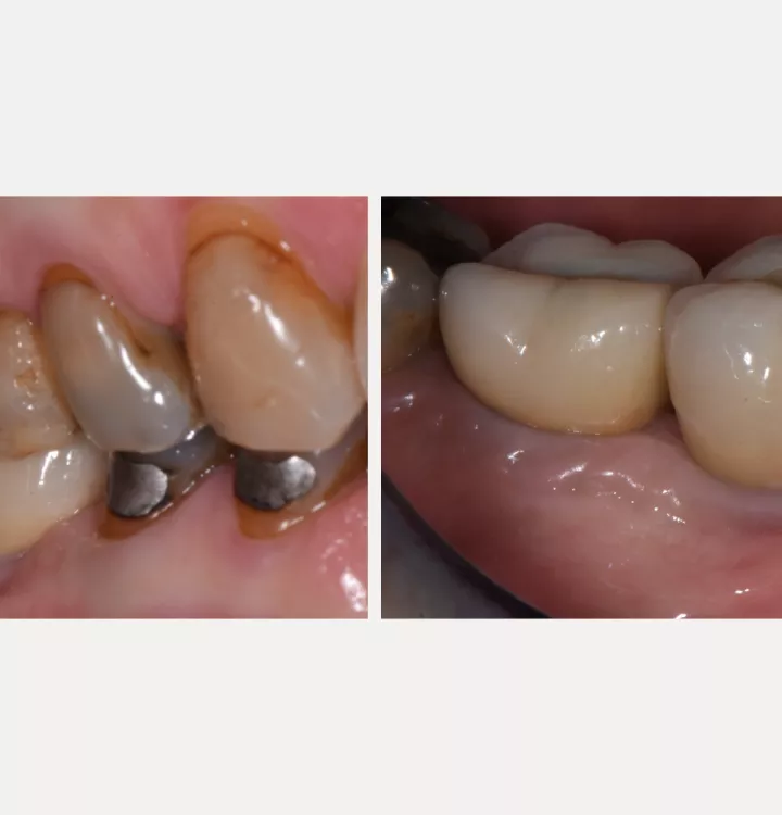 Nobel Biocare Clinical Case