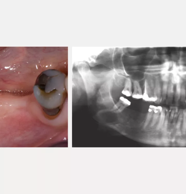 Nobel Biocare Clinical Case