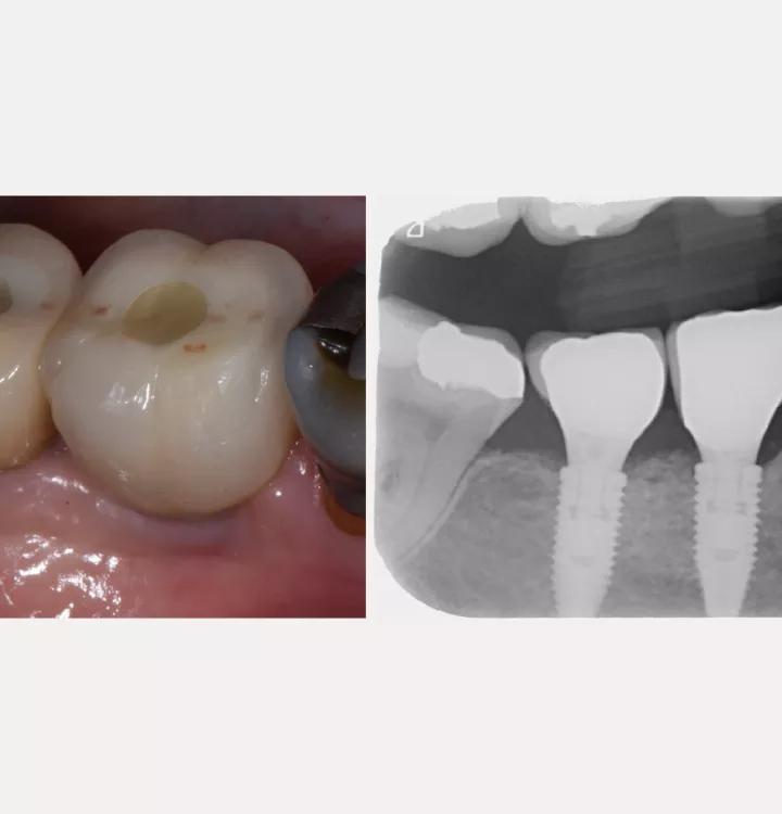 Nobel Biocare Clinical Case