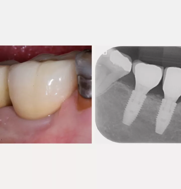 Nobel Biocare Clinical Case