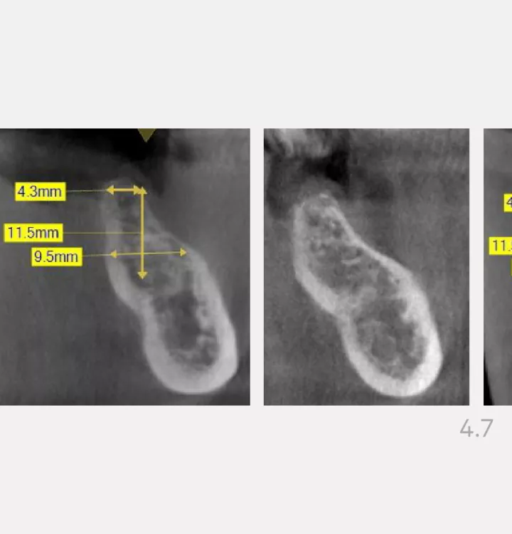 Nobel Biocare Clinical Case