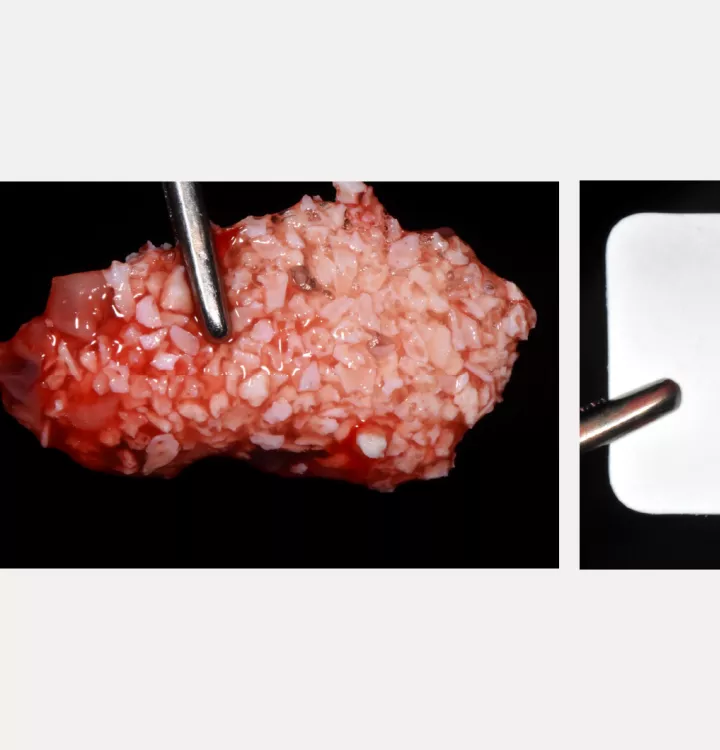 Nobel Biocare Clinical Case